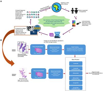 An AI based, open access screening tool for early diagnosis of Burkitt lymphoma